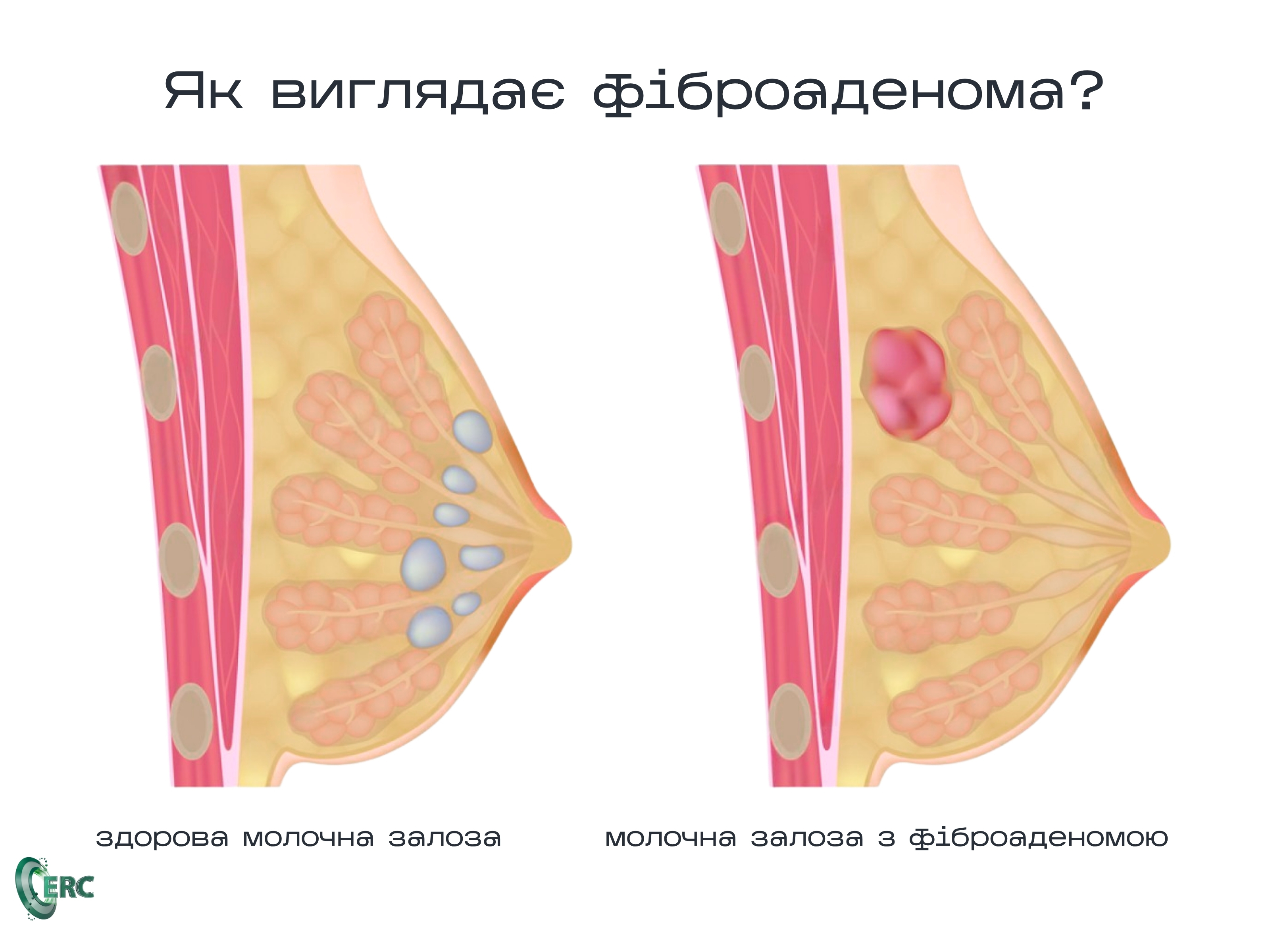 Як виглядає фіброаденома?