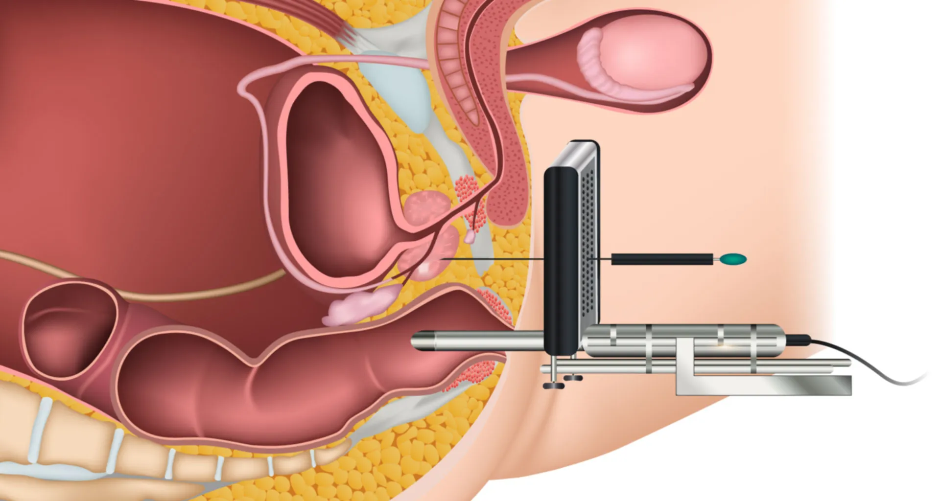 як роблять біопсію простати