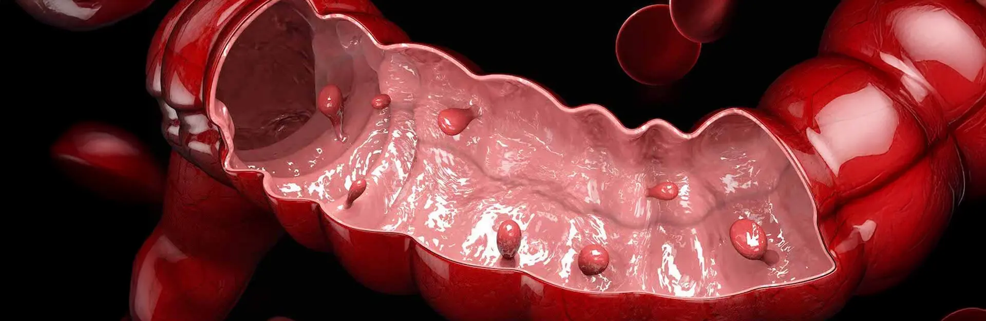 Що таке поліпи кишківника