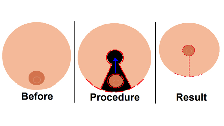 реконструктивна пластика грудей (мамопластика)