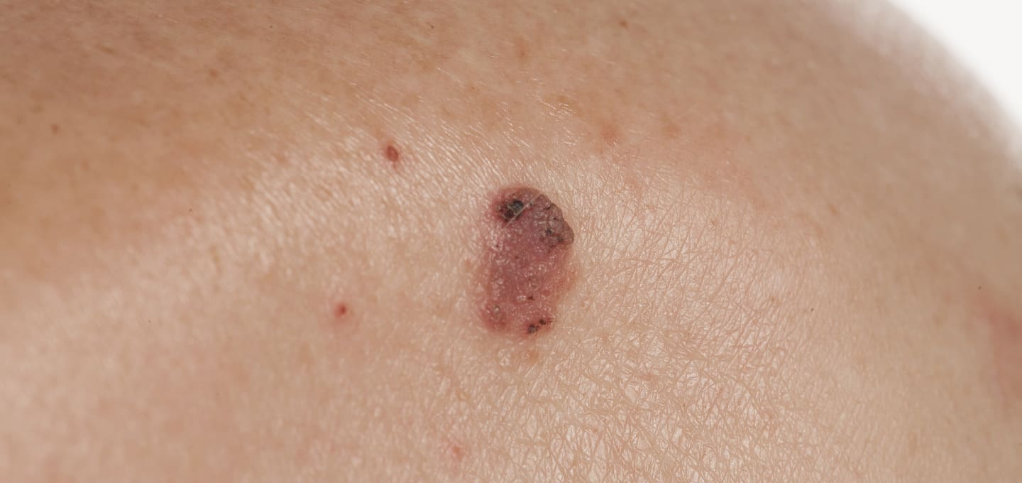 Причини плоскоклітинного раку шкіри