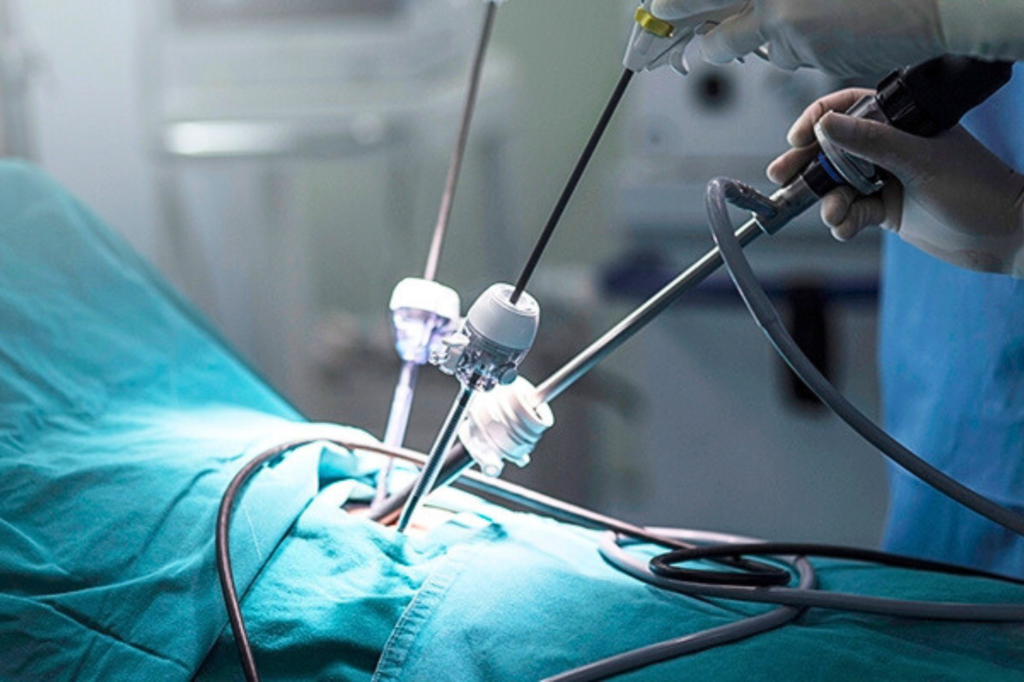 як проходить лапароскопія міоми матки