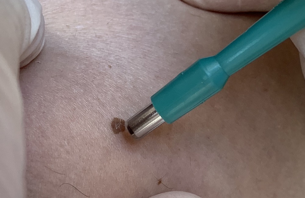 біопсія шкіри