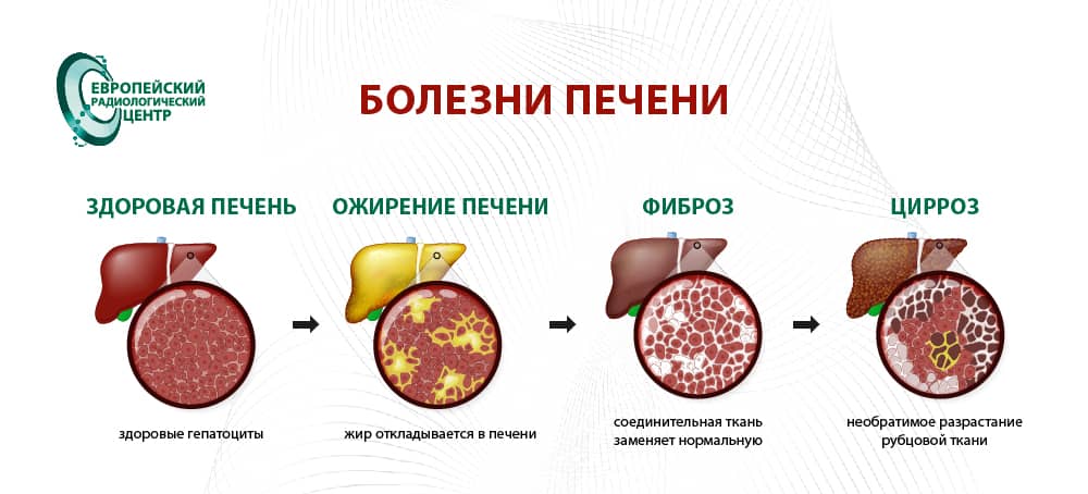 Site LiverDesease 1 RU