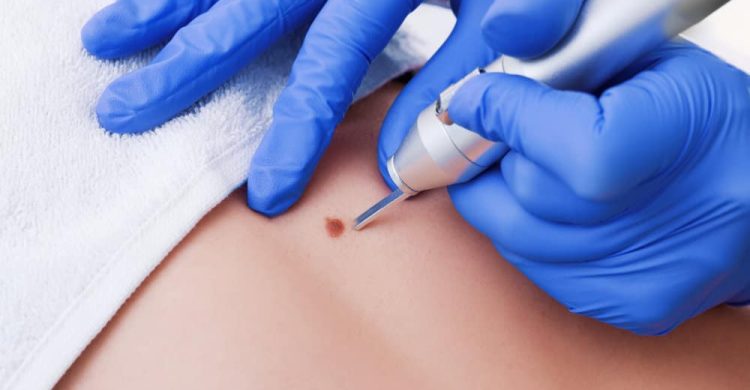 видалення ракових пухлин