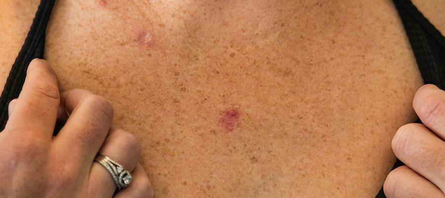 Лікування базаліоми