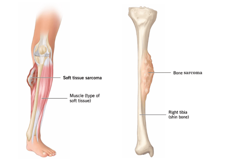 Симптоми саркоми