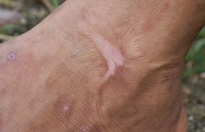 післяопікові та післятравматичні рубці