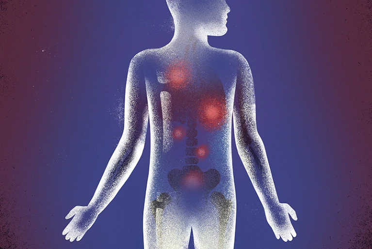 метастази раку простати