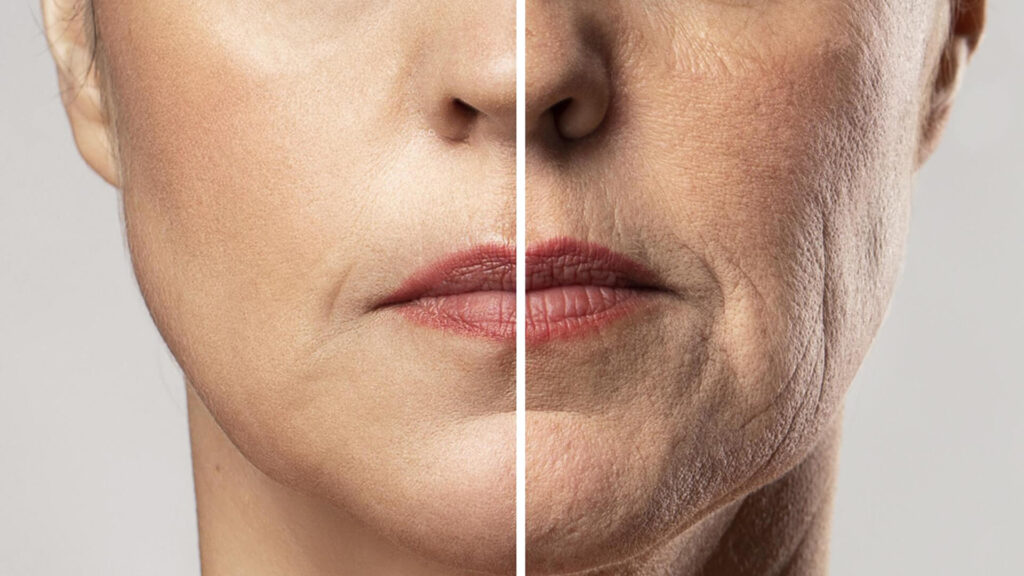 підтяжка нижньої третини обличчя