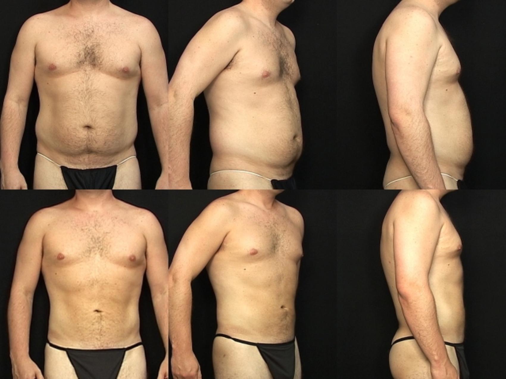 приклад результату до/після чоловічої ліпосакції