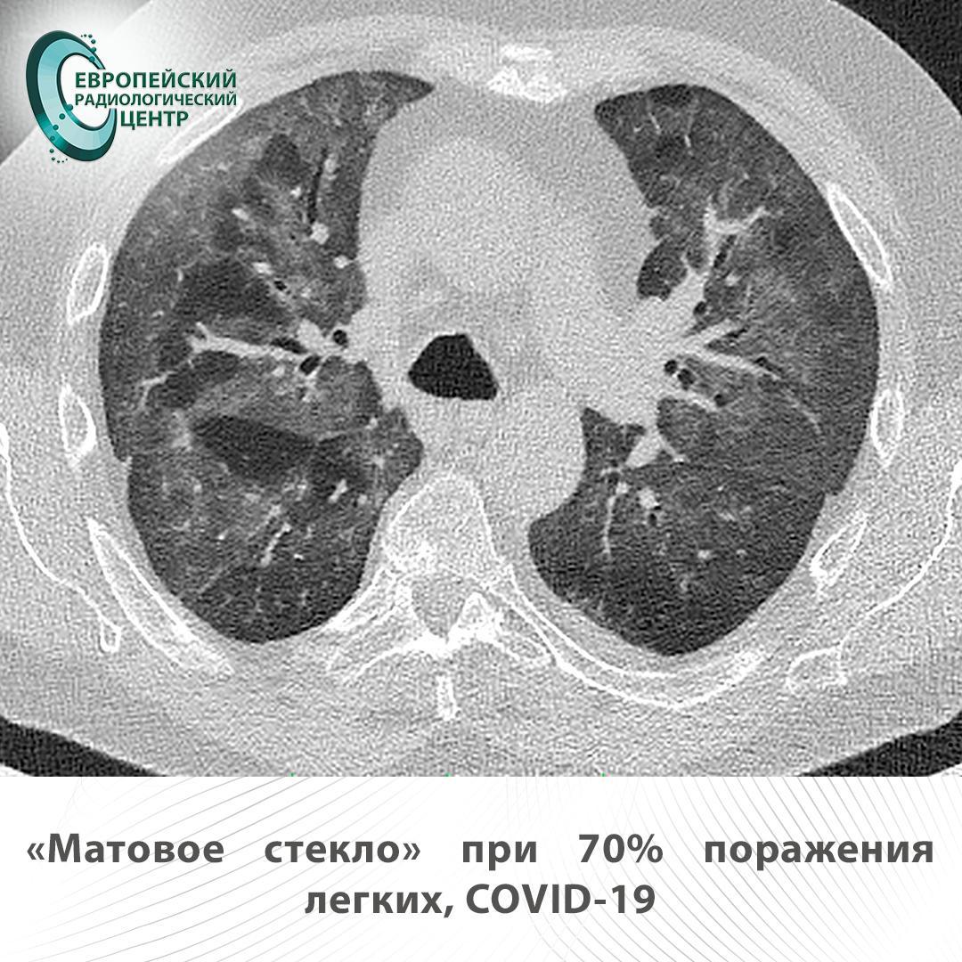 матовое стекло при 70% поражения легких