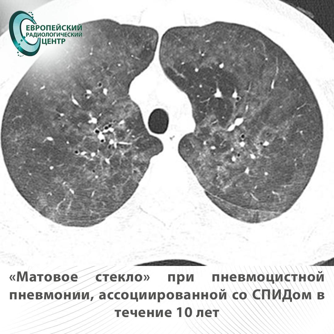 матовое стекло при пневмоцистной пневмонии ассоциированой со спидом