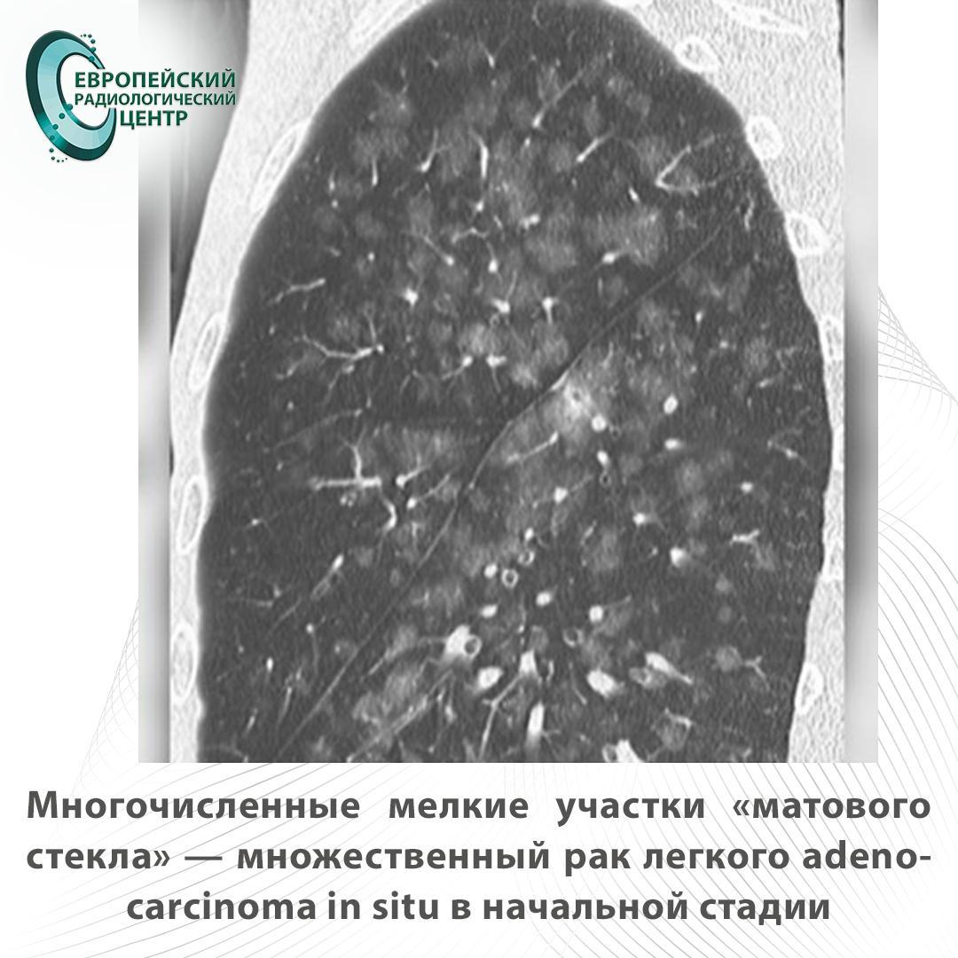 многочисленные мелкие участки матового стекла - множественный рак легкого в начальной стадии