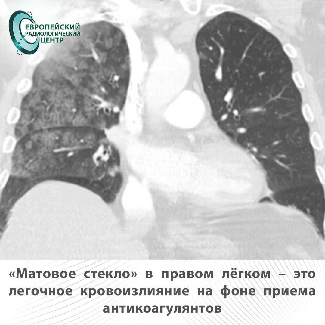 матовое стекло в правом легком - это легочное кровоизлияние на фоне приема антикоагулянтов