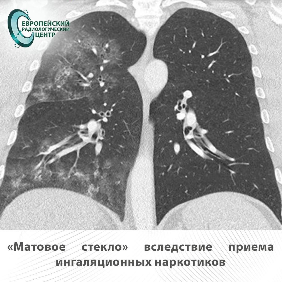 матовое стекло вследствие приема ингаляционных наркотиков
