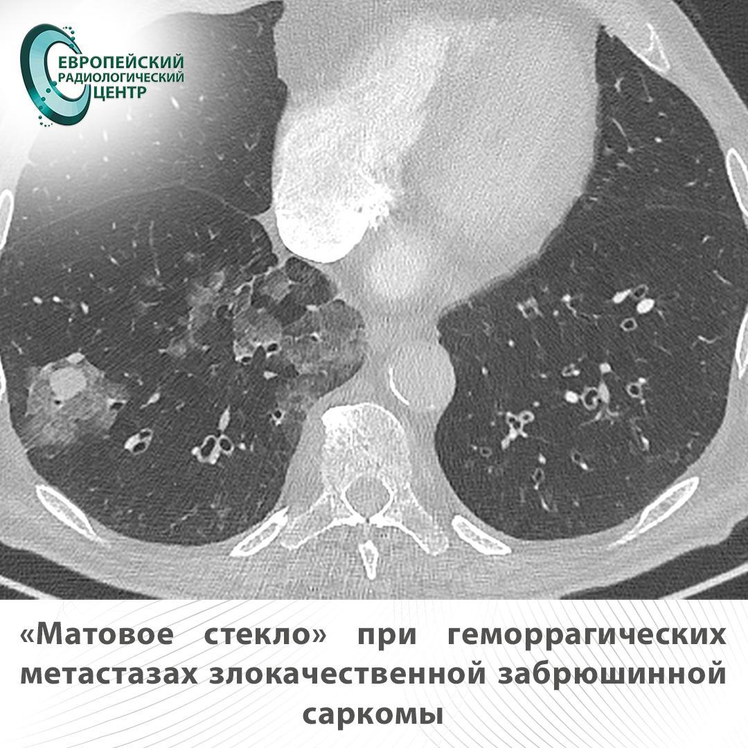 матовое стекло при метастазах