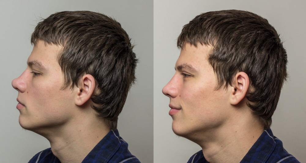 ринопластика для чоловіків