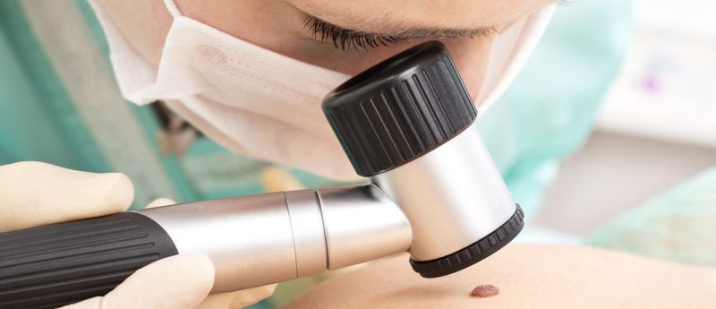 Показання до консультації дерматоонколога