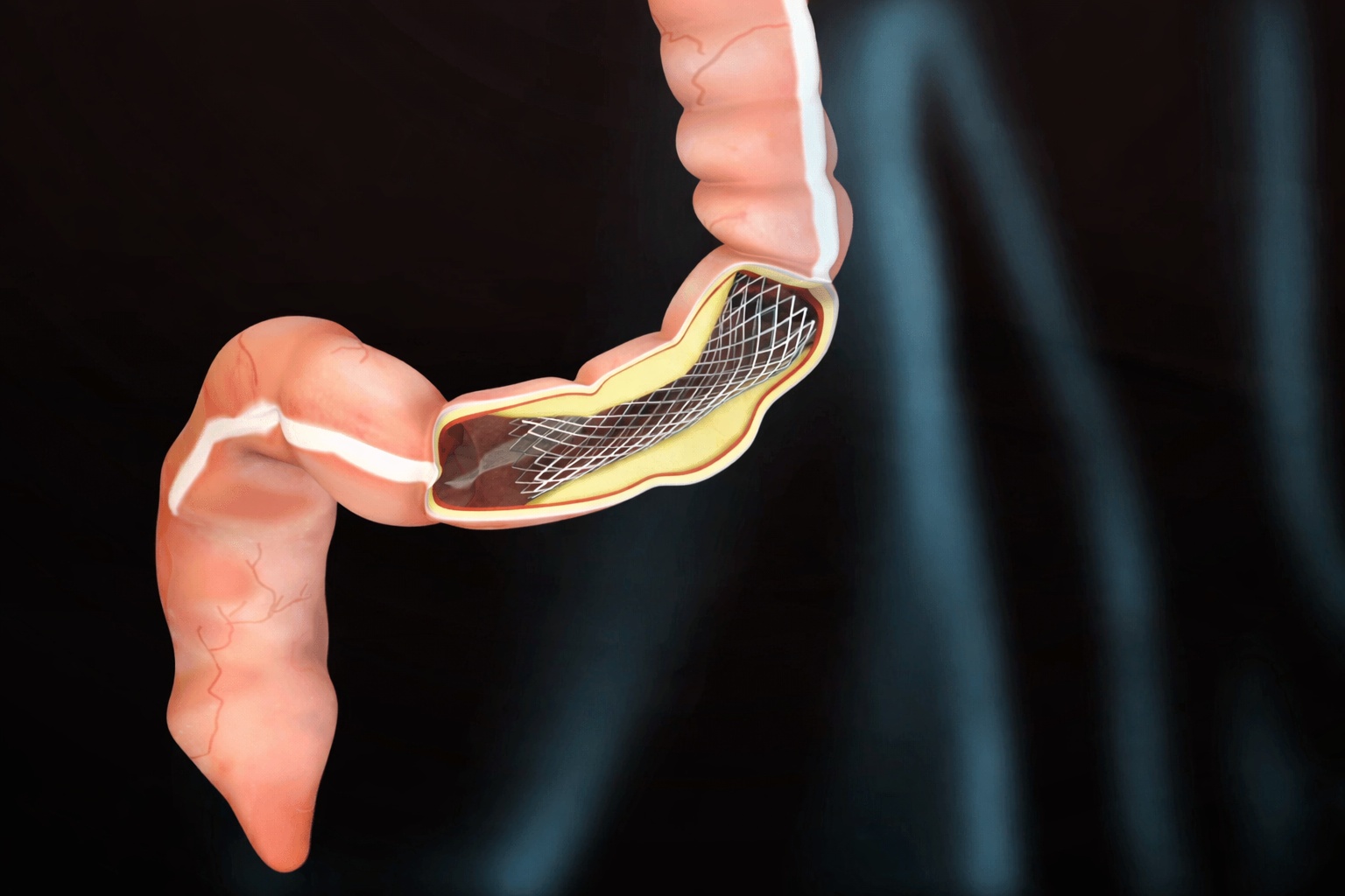 Стент у порожнині товстої кишки