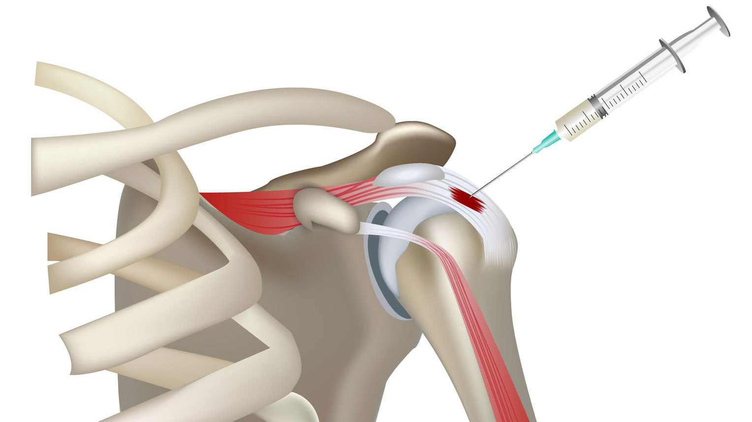 PRP-терапія (плазмотерапія) суглобів у ортопеда