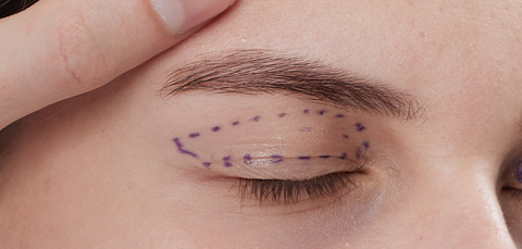 як проводиться блефаропластика